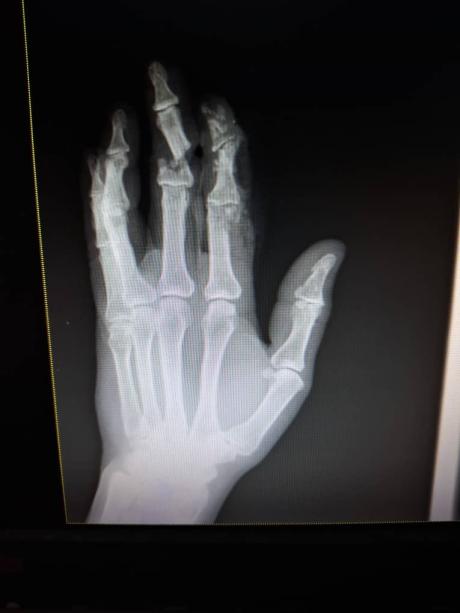 X-ray scan of of Israel's hand